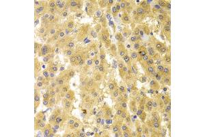 Immunohistochemistry of paraffin-embedded human liver cancer using GMNN antibody. (Geminin antibody)
