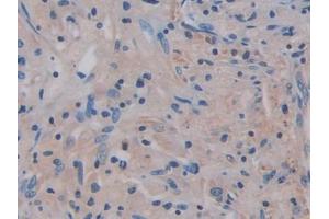 DAB staining on IHC-P; Samples: Human Lung cancer Tissue (IL17RA antibody  (AA 377-534))