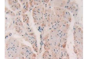 Detection of MYLK in Human Esophagus cancer Tissue using Polyclonal Antibody to Myosin Light Chain Kinase (MYLK) (MYLK antibody  (AA 1661-1877))