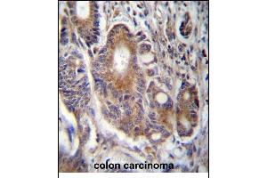 RAB21 Antibody (C-term) (ABIN657300 and ABIN2846383) immunohistochemistry analysis in formalin fixed and paraffin embedded human colon carcinoma followed by peroxidase conjugation of the secondary antibody and DAB staining. (RAB21 antibody  (C-Term))