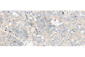 Immunohistochemistry of paraffin-embedded Human liver cancer tissue using ZNF449 Polyclonal Antibody at dilution of 1:50(x200) (ZNF449 antibody)