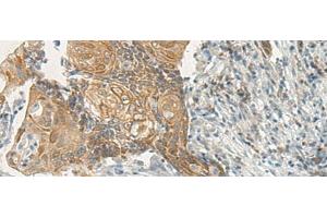 Immunohistochemistry of paraffin-embedded Human cervical cancer tissue using VIPR2 Polyclonal Antibody at dilution 1:35 (VIPR2 antibody)