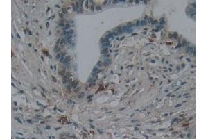 Detection of NPNT in Human Pancreatic cancer Tissue using Polyclonal Antibody to Nephronectin (NPNT) (Nephronectin antibody  (AA 418-565))