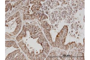 Immunoperoxidase of monoclonal antibody to ERBB3 on formalin-fixed paraffin-embedded human lung cancer. (ERBB3 antibody  (AA 21-331))