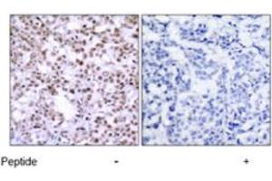 Immunohistochemical analysis of paraffin-embedded human breast carcinoma tissue using CHEK2 polyclonal antibody  .