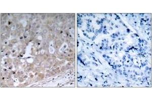 Immunohistochemistry analysis of paraffin-embedded human breast carcinoma tissue, using VEGFR2 (Ab-1175) Antibody.