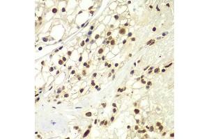 Immunohistochemistry of paraffin-embedded human kidney cancer using RPA2 Antibody (ABIN5971215) at dilution of 1/100 (40x lens). (RPA2 antibody)
