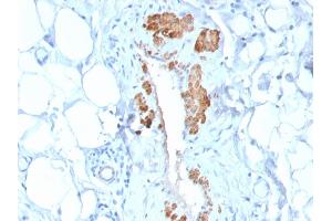 Formalin-fixed, paraffin-embedded human Breast Carcinoma stained with SM-MHC Recombinant Rabbit Monoclonal Antibody (MYH11/2303R). (Recombinant MYH11 antibody)