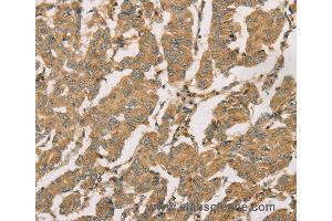 Immunohistochemistry of Human breast cancer using DMRT3 Polyclonal Antibody at dilution of 1:50 (DMRT3 antibody)