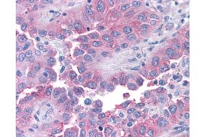 Anti-T1R1 / TAS1R1 antibody IHC of human Lung, Non-Small Cell Carcinoma. (TAS1R1 antibody  (Cytoplasmic Domain))