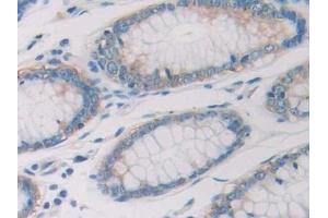 Detection of RNASE10 in Human Colorectal cancer Tissue using Polyclonal Antibody to Ribonuclease A10 (RNASE10) (Ribonuclease A10 (AA 27-216) antibody)