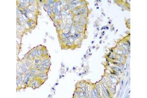 Immunohistochemistry of paraffin-embedded Human colon carcinoma using KRBOX4 Polyclonal Antibody at dilution of 1:200 (40x lens). (KRAB Box Domain Containing 4 (KRBOX4) antibody)