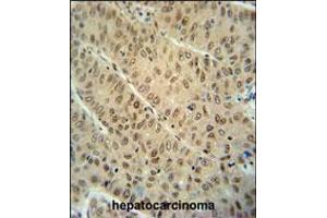 WDR32 antibody immunohistochemistry analysis in formalin fixed and paraffin embedded human hepatocarcinoma followed by peroxidase conjugation of the secondary antibody and DAB staining. (DCAF10 antibody  (N-Term))