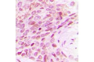Immunohistochemical analysis of POLR2E staining in human breast cancer formalin fixed paraffin embedded tissue section. (POLR2E antibody  (Center))