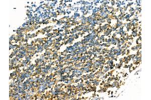 ABIN7094516 and ABIN7098565 at 1/100 staining Human breast cancer by IHC-P. (CD20 antibody  (C-Term))