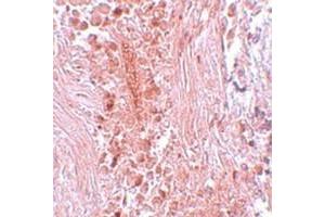 Immunohistochemical staining of human breast cancer tissue with PIAS3 polyclonal antibody  at 5 ug/mL dilution. (PIAS3 antibody  (C-Term))