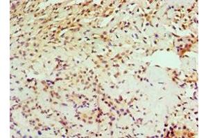 Immunohistochemistry of paraffin-embedded human breast cancer using ABIN7156734 at dilution of 1:100 (IL1RAP antibody  (AA 21-356))