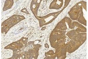 Immunohistochemical analysis of paraffin-embedded Human Colon cancer section using Pink1 . (SASH1 antibody  (AA 596-625))