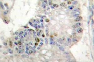 Immunohistochemistry (IHC) analyzes of Histone H1 antibody in paraffin-embedded human colon carcinoma tissue. (Histone H1 antibody)