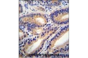 HSD11B1L Antibody (C-term) (ABIN655425 and ABIN2844963) immunohistochemistry analysis in formalin fixed and paraffin embedded human prostate carcinoma followed by peroxidase conjugation of the secondary antibody and DAB staining. (HSD11B1L antibody  (C-Term))