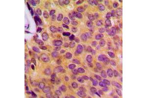 Immunohistochemical analysis of MOB3B staining in human breast cancer formalin fixed paraffin embedded tissue section. (MOBKL2B antibody  (Center))