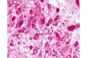 Anti-LPHN3 / Latrophilin-3 antibody IHC of human Brain, Glioblastoma. (LPHN3 antibody  (C-Term))