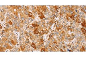Immunohistochemistry of paraffin-embedded Human liver cancer using CDC46 Polyclonal Antibody at dilution of 1:40 (MCM5 antibody)