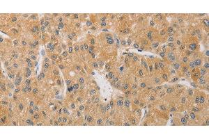 Immunohistochemistry of paraffin-embedded Human liver cancer tissue using ARSK Polyclonal Antibody at dilution 1:30 (Arylsulfatase K antibody)