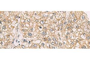 Immunohistochemistry of paraffin-embedded Human liver cancer tissue using CHST2 Polyclonal Antibody at dilution of 1:30(x200) (CHST2 antibody)