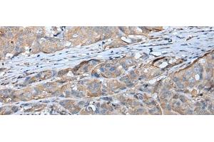 Immunohistochemistry of paraffin-embedded Human breast cancer tissue using GPC5 Polyclonal Antibody at dilution of 1:40(x200) (GPC5 antibody)