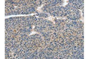 The image on the left is immunohistochemistry of paraffin-embedded Human liver cancer tissue using ABIN7128589(ATP4B Antibody) at dilution 1/40, on the right is treated with fusion protein. (ATP4b antibody)