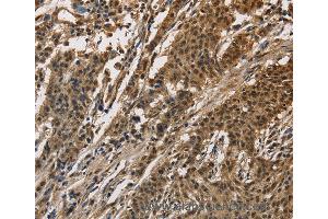 Immunohistochemistry of Human liver cancer using CCAR1 Polyclonal Antibody at dilution of 1:40 (CCAR1 antibody)
