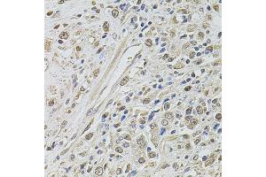 Immunohistochemistry of paraffin-embedded human prostate cancer using SMARCC2 antibody (ABIN5971018) at dilution of 1/100 (40x lens). (SMARCC2 antibody)