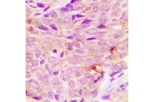 Immunohistochemical analysis of PIGF staining in human breast cancer formalin fixed paraffin embedded tissue section. (PIGF antibody  (C-Term))