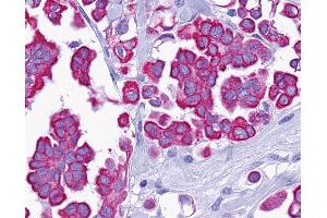 Anti-P2RY14 / GPR105 antibody IHC of human Ovary, Carcinoma. (P2RY14 antibody  (C-Term))