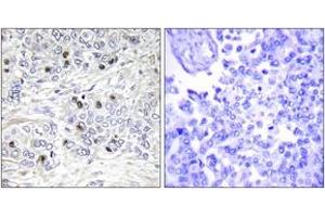 Immunohistochemistry analysis of paraffin-embedded human breast carcinoma tissue, using TEAD2 Antibody. (TEAD2 antibody  (AA 71-120))