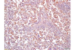 Formalin-fixed and paraffin embedded human lung carcinoma labeled with Anti MT-ND5Polyclonal Antibody (ABIN751633), Unconjugated at 1:200, followed by conjugation to the secondary antibody and DAB staining (MT-ND5 antibody  (AA 451-550))