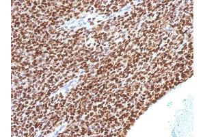 Formalin-fixed, paraffin-embedded human Ewing's Sarcoma stained with NKX2.