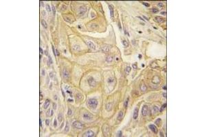 Formalin-fixed and paraffin-embedded human lung carcinoma tissue reacted with EphB2 antibody, which was peroxidase-conjugated to the secondary antibody, followed by DAB staining. (EPH Receptor B2 antibody)