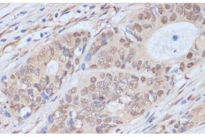 Immunohistochemistry of paraffin-embedded Human colon carcinoma using CDK9 Polyclonal Antibody at dilution of 1:100 (40x lens). (CDK9 antibody)