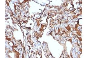 Formalin-fixed, paraffin-embedded human melanoma stained with CD146 antibody (MUC18/1130)