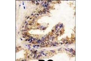 Formalin-fixed and paraffin-embedded human prostata carcinoma reacted with BRAF Antibody (Center) (ABIN392246 and ABIN2841936) , which was peroxidase-conjugated to the secondary antibody, followed by DAB staining. (SNRPE antibody  (AA 424-453))