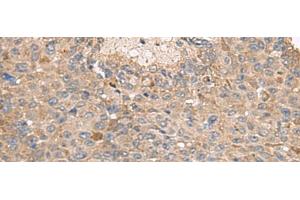 Immunohistochemistry of paraffin-embedded Human liver cancer tissue using ABCA10 Polyclonal Antibody at dilution of 1:50(x200) (ABCA10 antibody)