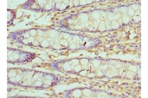Immunohistochemistry of paraffin-embedded human colon cancer using ABIN7175510 at dilution of 1:100