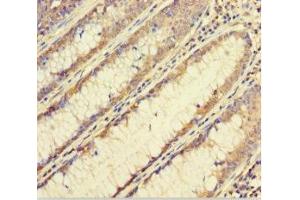 Immunohistochemistry of paraffin-embedded human colon cancer using ABIN7152460 at dilution of 1:100 (FBXL17 antibody  (AA 1-303))