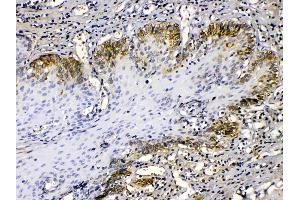 Cytokeratin 14 was detected in paraffin-embedded sections of human oesophagus squama cancer tissues using rabbit anti- Cytokeratin 14 Antigen Affinity purified polyclonal antibody (Catalog # ) at 1 µg/mL. (KRT14 antibody  (C-Term))