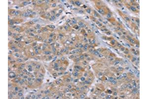The image on the left is immunohistochemistry of paraffin-embedded Human liver cancer tissue using ABIN7192260(SAMD9 Antibody) at dilution 1/35, on the right is treated with synthetic peptide. (SAMD9 antibody)