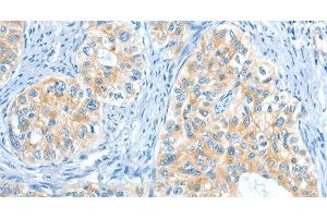 Immunohistochemistry of paraffin-embedded Human cervical cancer tissue using COL4A2 Polyclonal Antibody at dilution 1:70 (COL4a2 antibody)