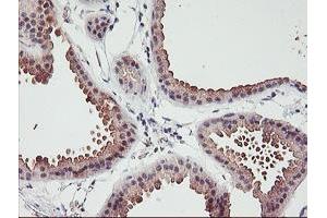 Immunohistochemical staining of paraffin-embedded Human breast tissue using anti-ERCC1 mouse monoclonal antibody. (ERCC1 antibody)