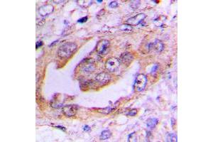 Immunohistochemical analysis of EG5 (pT926) staining in human lung cancer formalin fixed paraffin embedded tissue section. (KIF11 antibody  (C-Term, pSer926))